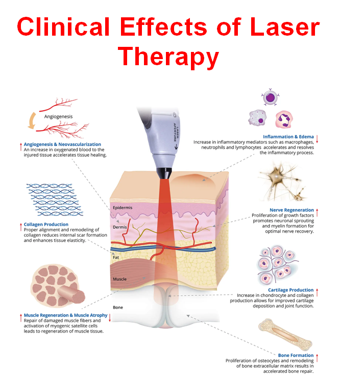 Clinical effect of Laser Therapy at Quality Life Physio Brampton